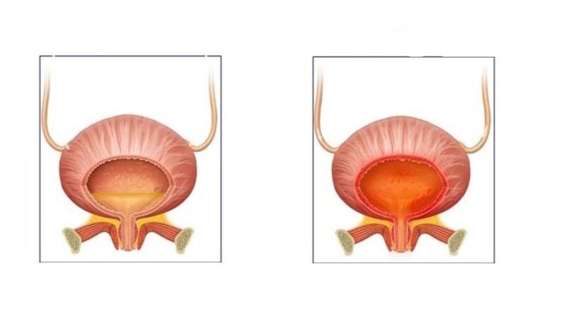 Normalūs ir pacientai, sergantys šlapimo tako cistitu