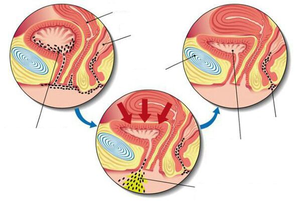 bakterijos šlapimo pūslėje su cistitu