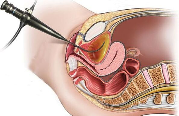 cistoskopija dėl cistito