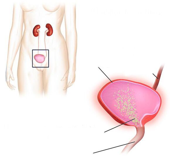 šlapimo pūslės uždegimas